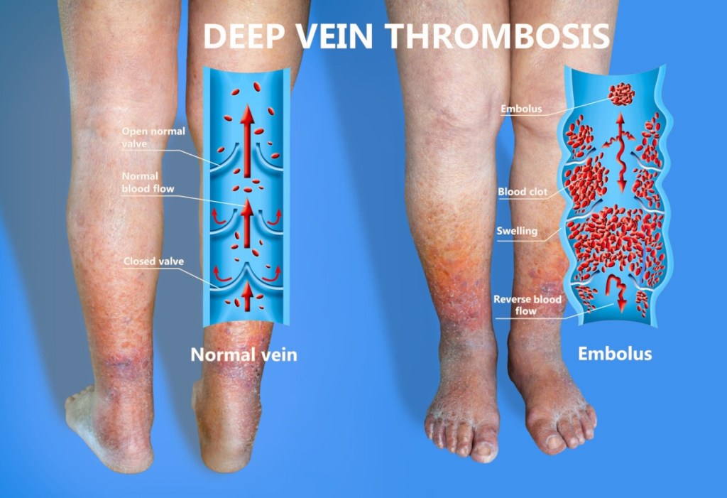 Scoperto il “difetto” dei coaguli: cosa succede con&nbsp;AstraZeneca
